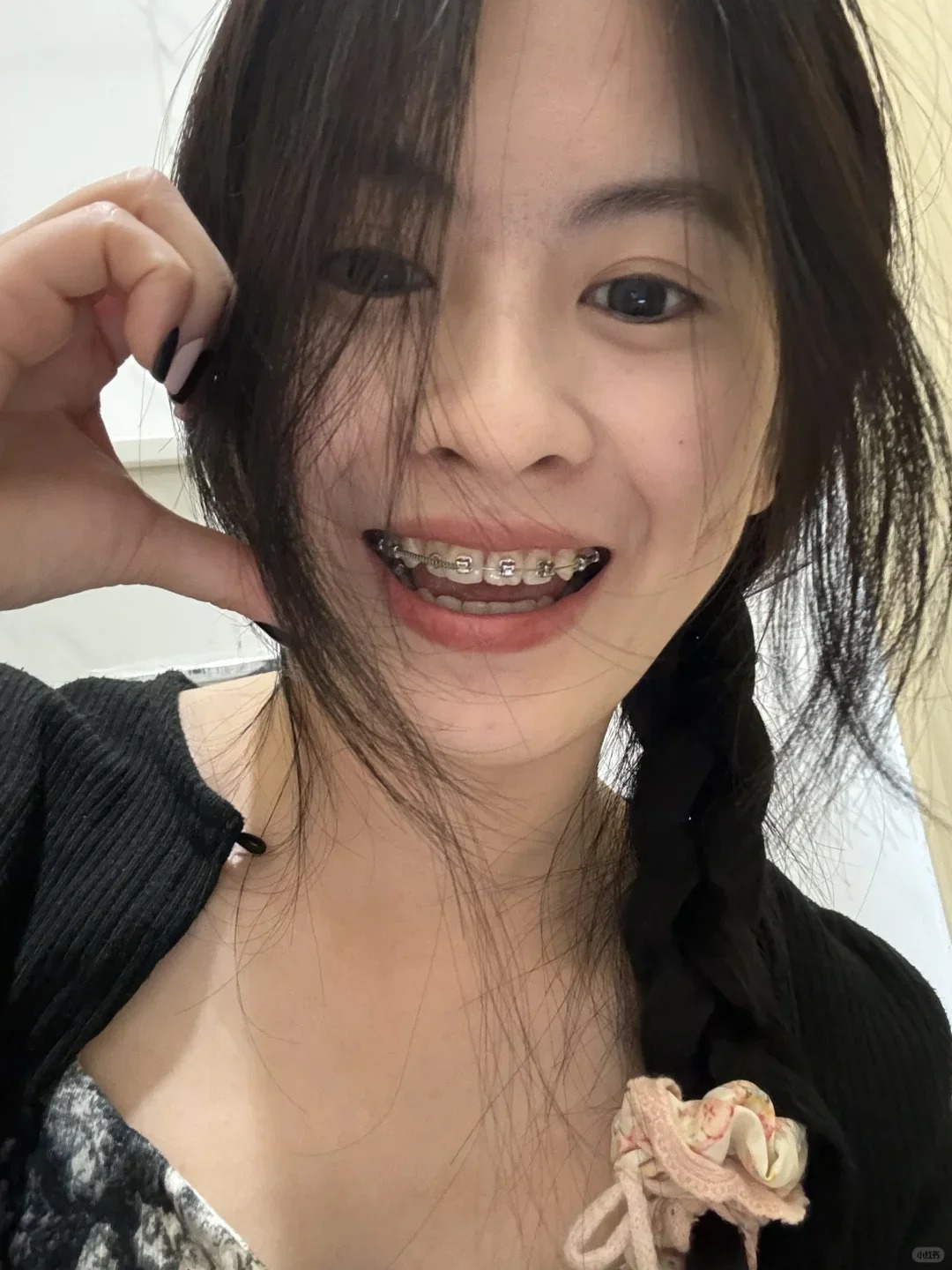 Chỉnh nha kiểu Meaw - Geaw: Vì sao được giới trẻ săn đón? - Ảnh 8. Chỉnh nha kiểu Meaw - Geaw: Vì sao được giới trẻ săn đón? - Ảnh 8.