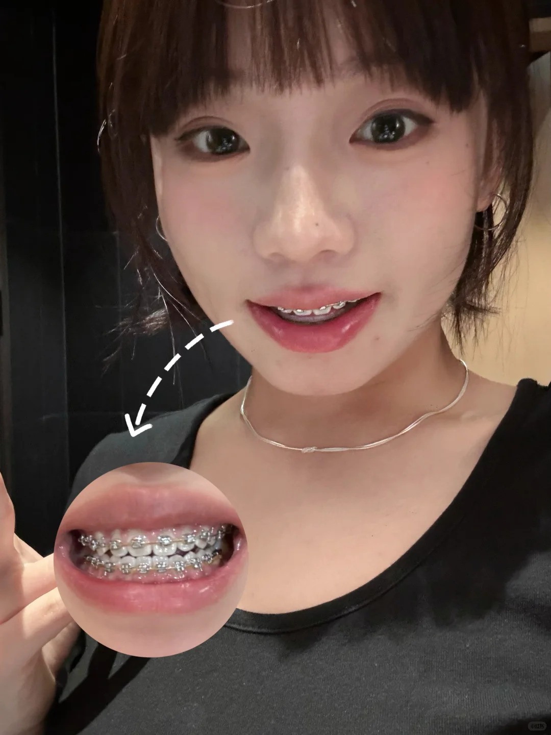 Chỉnh nha kiểu Meaw - Geaw: Vì sao được giới trẻ săn đón? - Ảnh 9. Chỉnh nha kiểu Meaw - Geaw: Vì sao được giới trẻ săn đón? - Ảnh 9.
