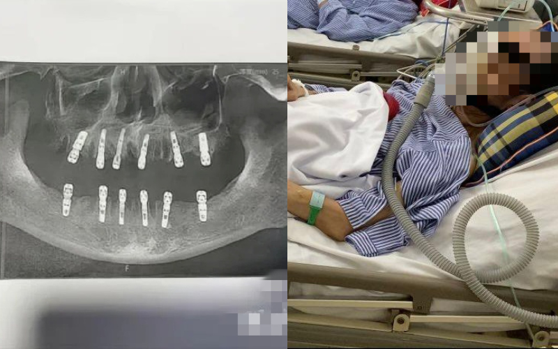 Cụ ông 77 tuổi qua đời sau khi cấy 6 implant và nhổ 12 răng: Có phải càng nhiều tuổi càng không nên nhổ răng, cấy implant?