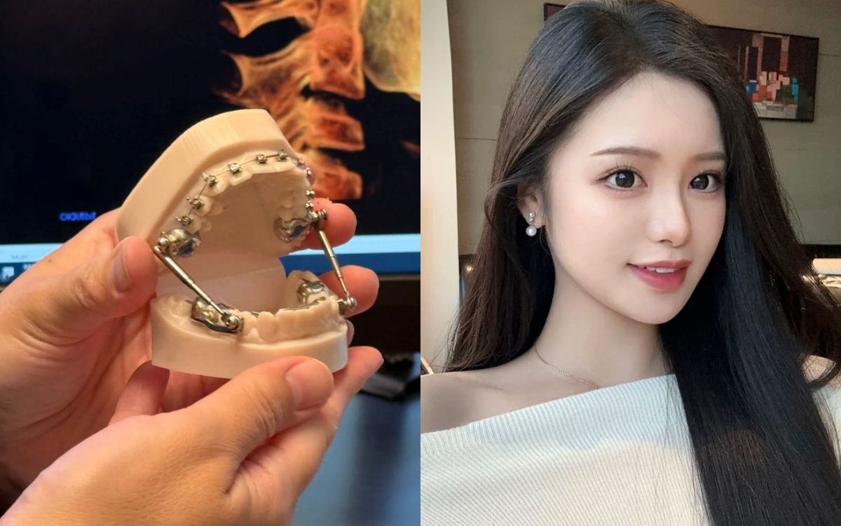 Chỉnh nha kiểu Meaw - Geaw: Vì sao được giới trẻ săn đón? - Ảnh 1. Chỉnh nha kiểu Meaw - Geaw: Vì sao được giới trẻ săn đón? - Ảnh 1.