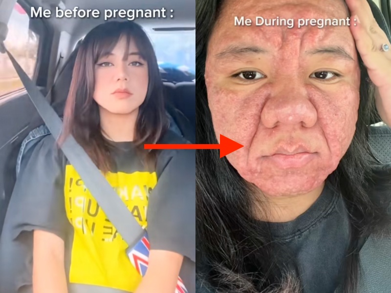 Mẹ bỉm 28 tuổi chia sẻ hình ảnh mang thai với gương mặt biến đổi hoàn toàn khiến cả cõi mạng dậy sóng- Ảnh 5. Mẹ bỉm 28 tuổi chia sẻ hình ảnh mang thai với gương mặt biến đổi hoàn toàn khiến cả cõi mạng dậy sóng- Ảnh 5.