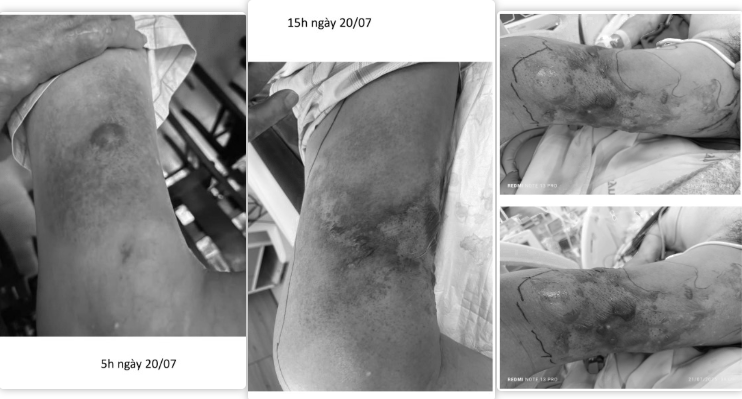 Bị "đốt" khi tắm biển, người đ&agrave;n &ocirc;ng nhiễm tr&ugrave;ng hoại tử khắp đ&ugrave;i, rơi v&agrave;o nguy kịch - Ảnh 1.