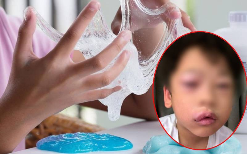 Bé trai 5 tuổi bị sưng mặt, nôn ói sau 30 phút chơi slime: Cảnh báo cha mẹ cho con chơi &quot;chất nhờn ma quái&quot;