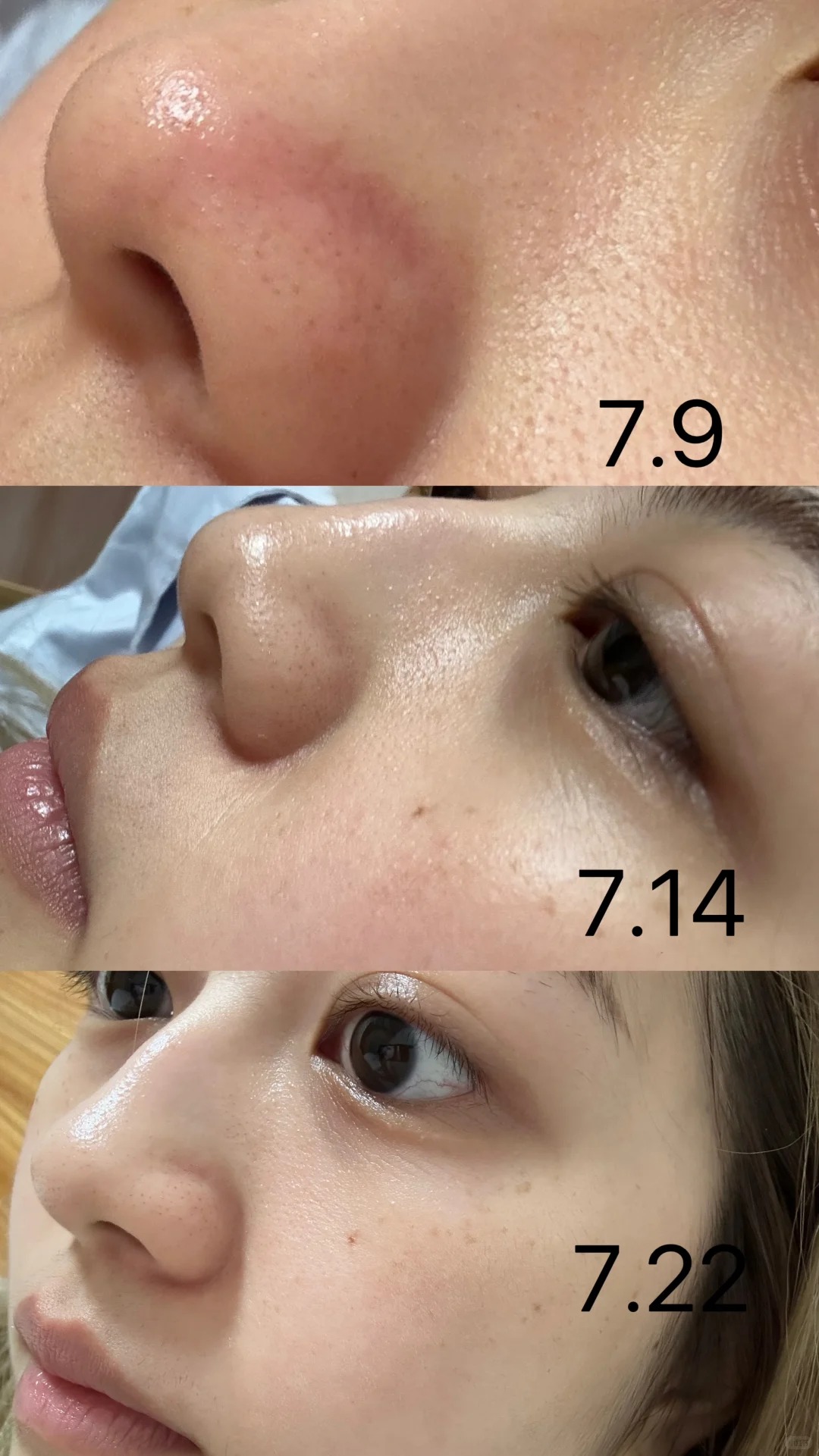Lỗ chân lông nhỏ đi thấy rõ sau 1 tháng cô nàng này dùng bộ đôi serum dưỡng da bình dân của Hàn - Ảnh 8.