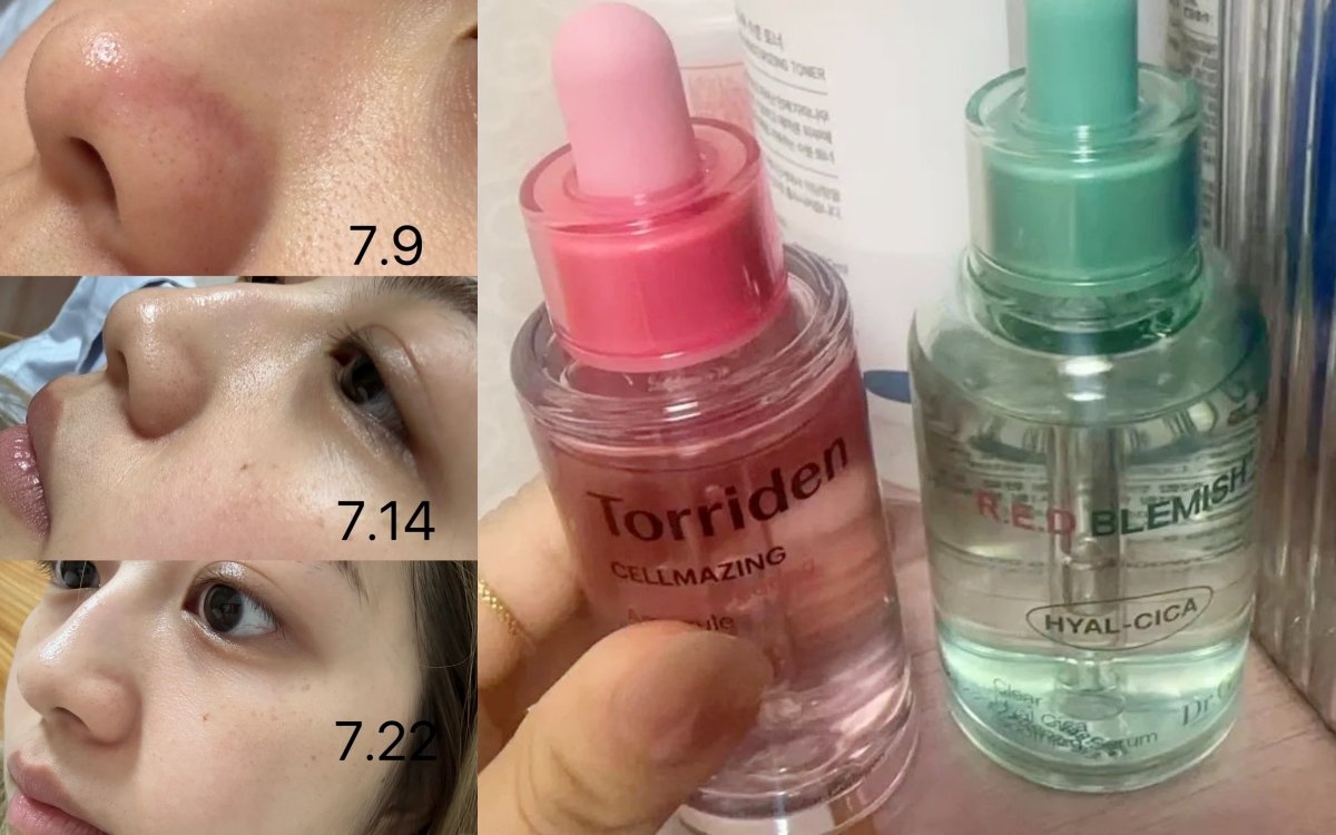 Lỗ chân lông nhỏ đi thấy rõ sau 1 tháng cô nàng này dùng bộ đôi serum dưỡng da bình dân của Hàn - Ảnh 2.