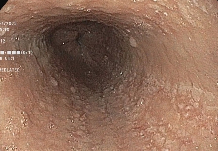 Người phụ nữ đi kh&aacute;m v&igrave; nuốt nghẹn, ph&aacute;t hiện 6 bệnh c&ugrave;ng l&uacute;c - Ảnh 2.