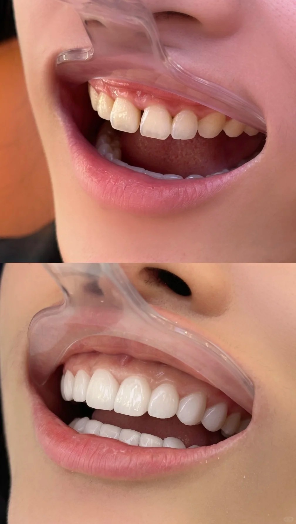 Đừng để răng sứ &quot;làm hỏng nụ cười&quot; khi mắc phải những sai lầm cơ bản này - Ảnh 4.