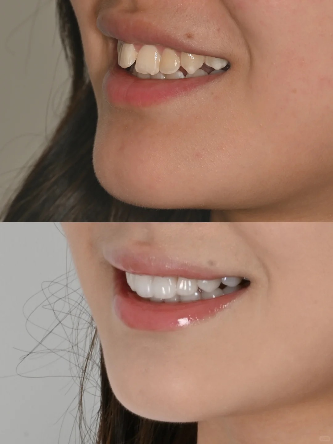 Đừng để răng sứ &quot;làm hỏng nụ cười&quot; khi mắc phải những sai lầm cơ bản này - Ảnh 2.