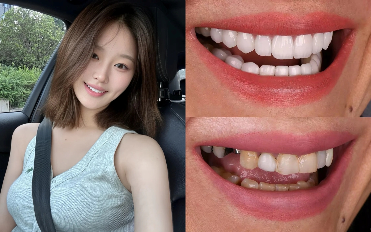 Đừng để răng sứ &quot;làm hỏng nụ cười&quot; khi mắc phải những sai lầm cơ bản này - Ảnh 1.