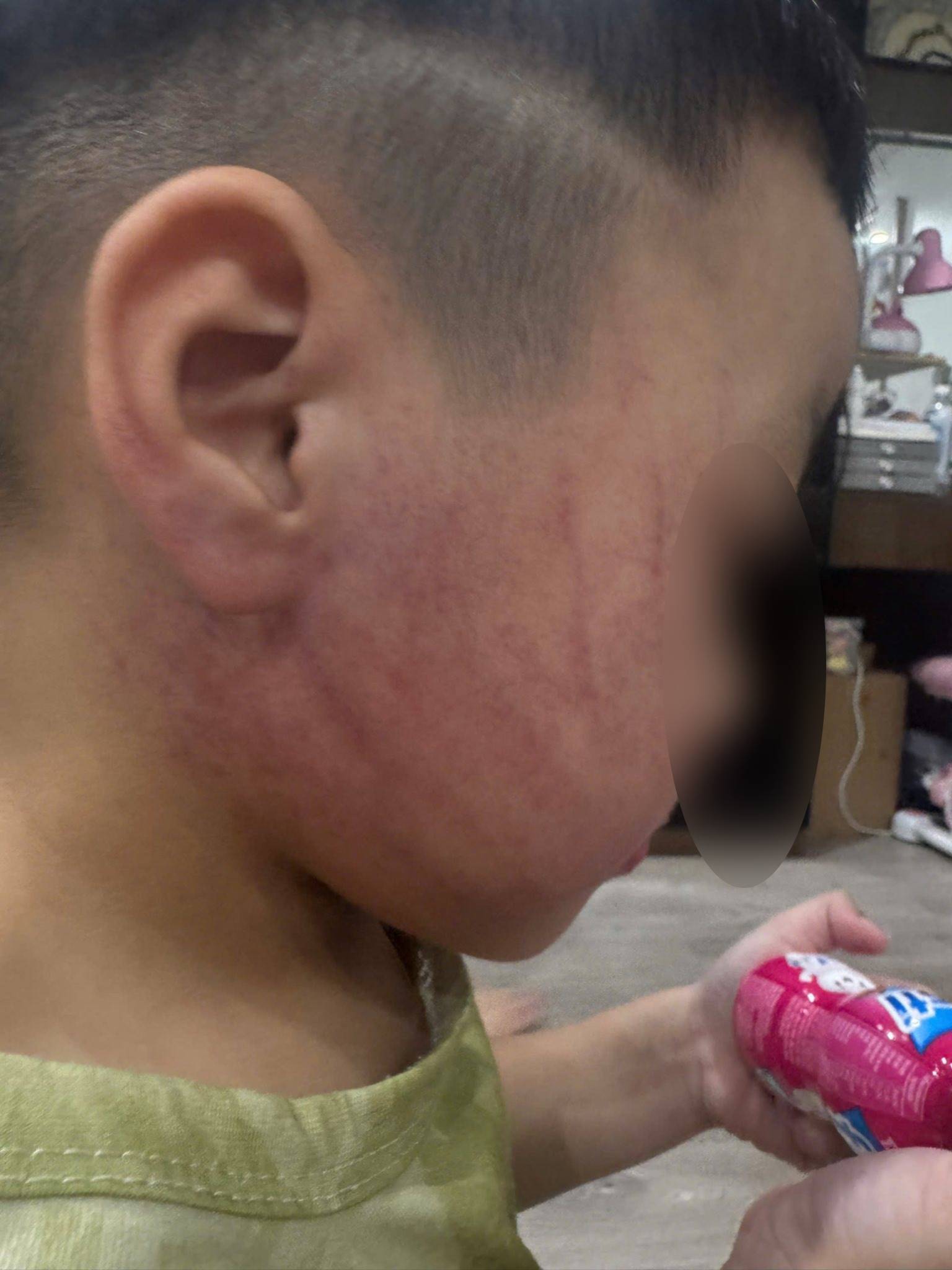 Xôn xao hình ảnh bé trai ở Hà Nội bị đánh tím mặt, phụ huynh phẫn nộ tố đích danh giáo viên- Ảnh 3. Xôn xao hình ảnh bé trai ở Hà Nội bị đánh tím mặt, phụ huynh phẫn nộ tố đích danh giáo viên- Ảnh 3.