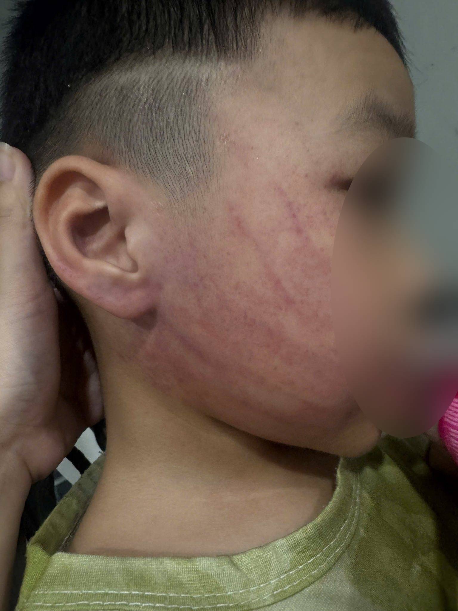 Xôn xao hình ảnh bé trai ở Hà Nội bị đánh tím mặt, phụ huynh phẫn nộ tố đích danh giáo viên- Ảnh 2. Xôn xao hình ảnh bé trai ở Hà Nội bị đánh tím mặt, phụ huynh phẫn nộ tố đích danh giáo viên- Ảnh 2.