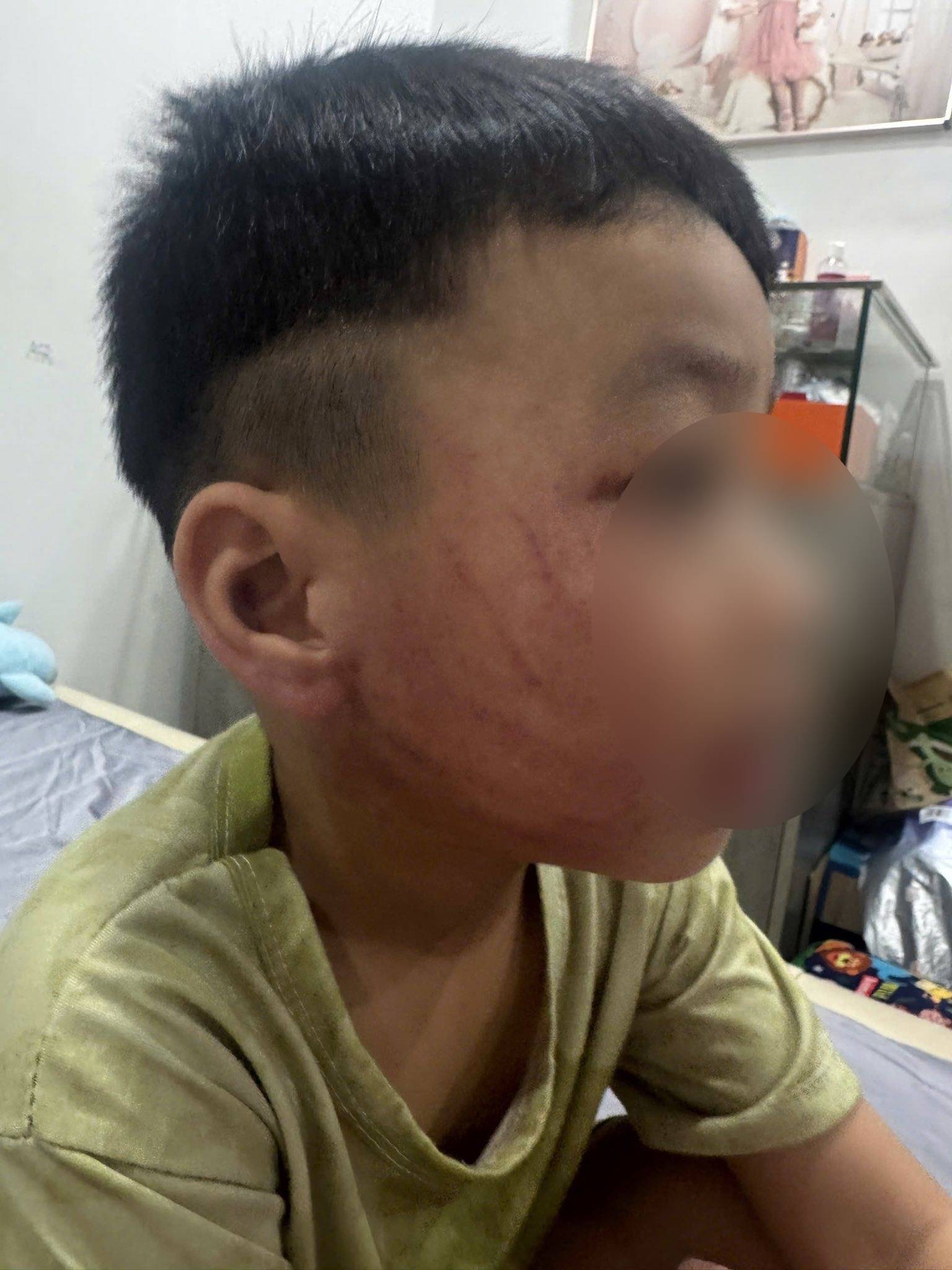 Xôn xao hình ảnh bé trai ở Hà Nội bị đánh tím mặt, phụ huynh phẫn nộ tố đích danh giáo viên- Ảnh 1. Xôn xao hình ảnh bé trai ở Hà Nội bị đánh tím mặt, phụ huynh phẫn nộ tố đích danh giáo viên- Ảnh 1.