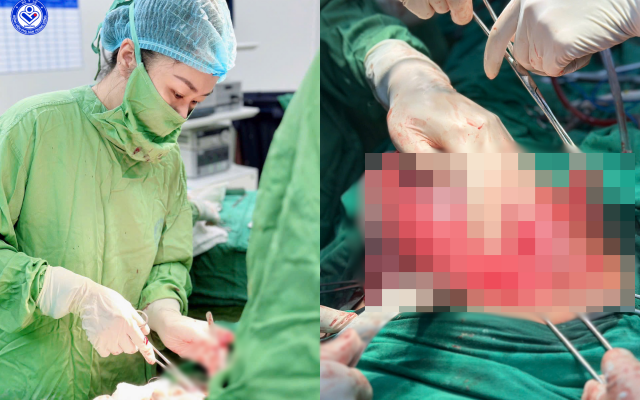 Mổ cấp cứu cho sản phụ mang thai 34 tuần có ruột thừa vỡ mủn nát: Ca mổ liên viện cứu sống cả hai mẹ con trong gang tấc - Ảnh 1. Mổ cấp cứu cho sản phụ mang thai 34 tuần có ruột thừa vỡ mủn nát: Ca mổ liên viện cứu sống cả hai mẹ con trong gang tấc - Ảnh 1.