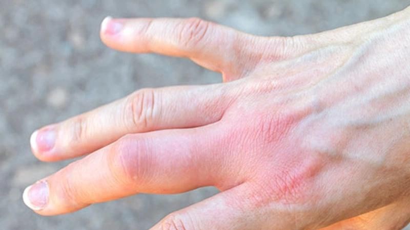 5 dấu hiệu xấu xí trên bàn tay cảnh báo thận của bạn đang kêu cứu!- Ảnh 3. 5 dấu hiệu xấu xí trên bàn tay cảnh báo thận của bạn đang kêu cứu!- Ảnh 3.