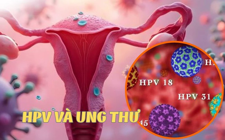 Bạn biết g&igrave; về HPV - T&aacute;c nh&acirc;n tăng nguy cơ ung thư cổ tử cung?