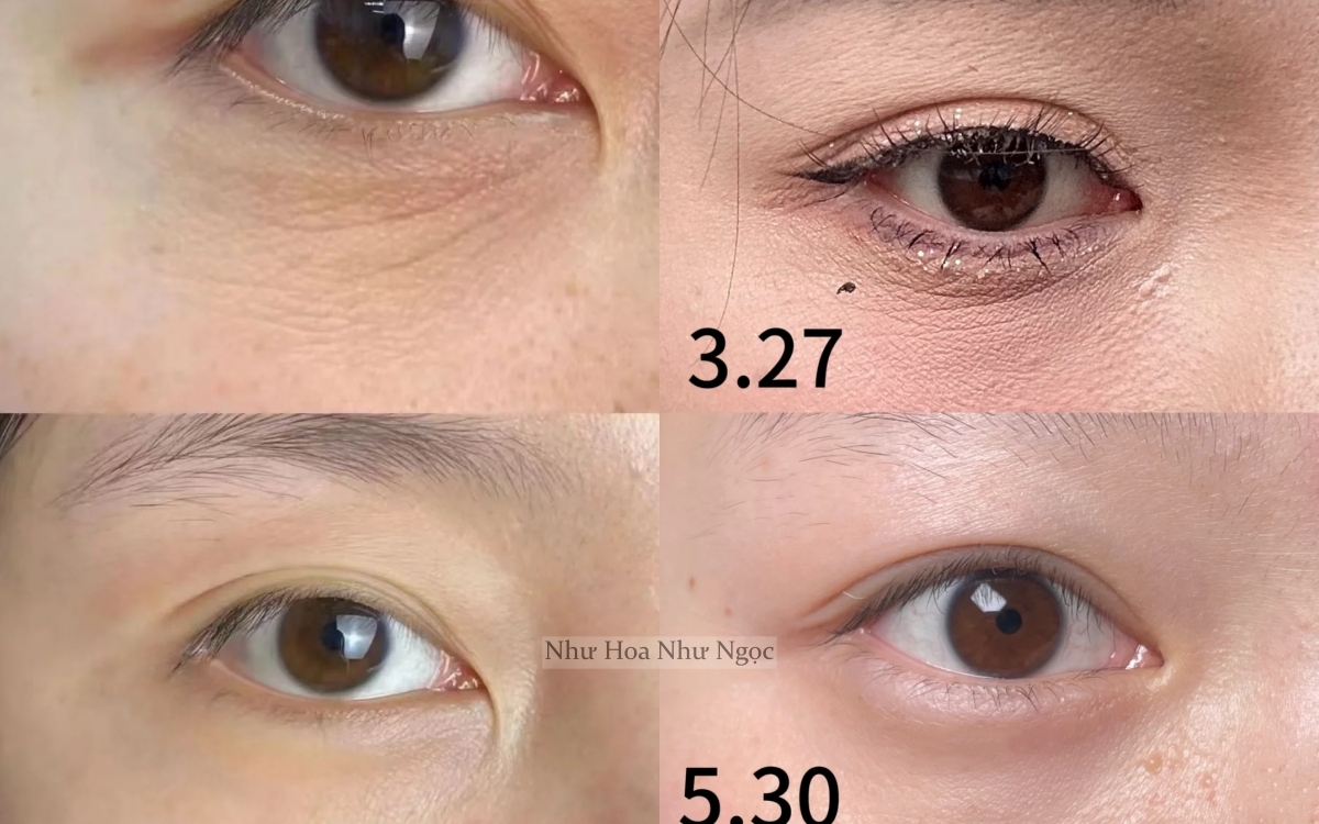 Cô nàng đắp cơm lên mắt, tưởng vô dụng nhưng bất ngờ khiến nếp nhăn giảm đi thấy rõ - Ảnh 2.