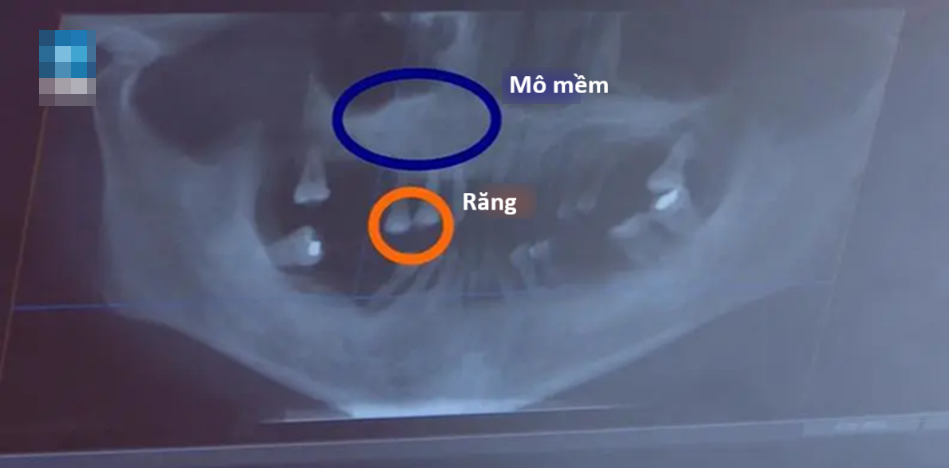 Người phụ nữ 44 tuổi rụng gần hết răng vì thói quen ai cũng dễ bỏ qua- Ảnh 2. Người phụ nữ 44 tuổi rụng gần hết răng vì thói quen ai cũng dễ bỏ qua- Ảnh 2.