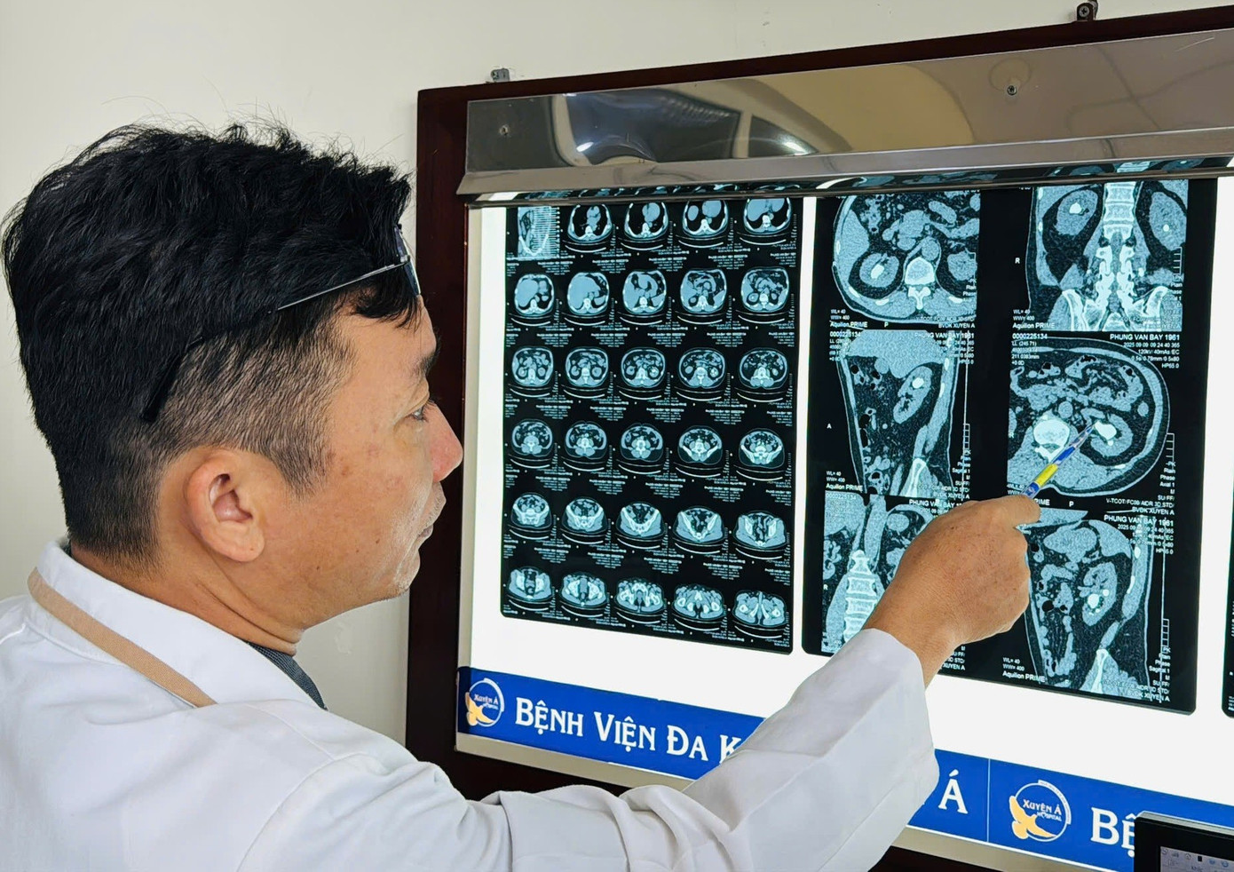 Người đàn ông bị 'sát thủ' sỏi san hô khổng lồ phá hủy thận - Ảnh 1. Người đàn ông bị 'sát thủ' sỏi san hô khổng lồ phá hủy thận - Ảnh 1.