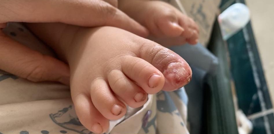 Con bị cục biến áp điện rơi vào chân đến biến dạng nhưng mẹ không dám cho đi khám vì bà ngoại mắng 