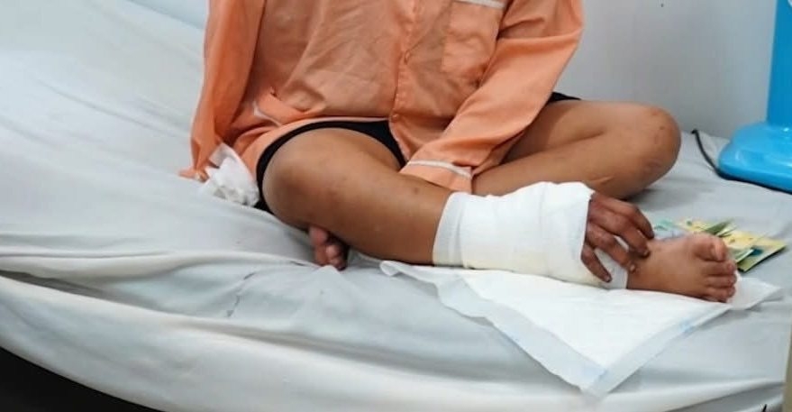 Thai phụ mang song thai được ghép tạm bàn tay đứt lìa vào chân sau tai nạn: Vì sao phải ghép tạm vào chân chứ không nối thẳng vào tay ngay lúc đó?- Ảnh 1.