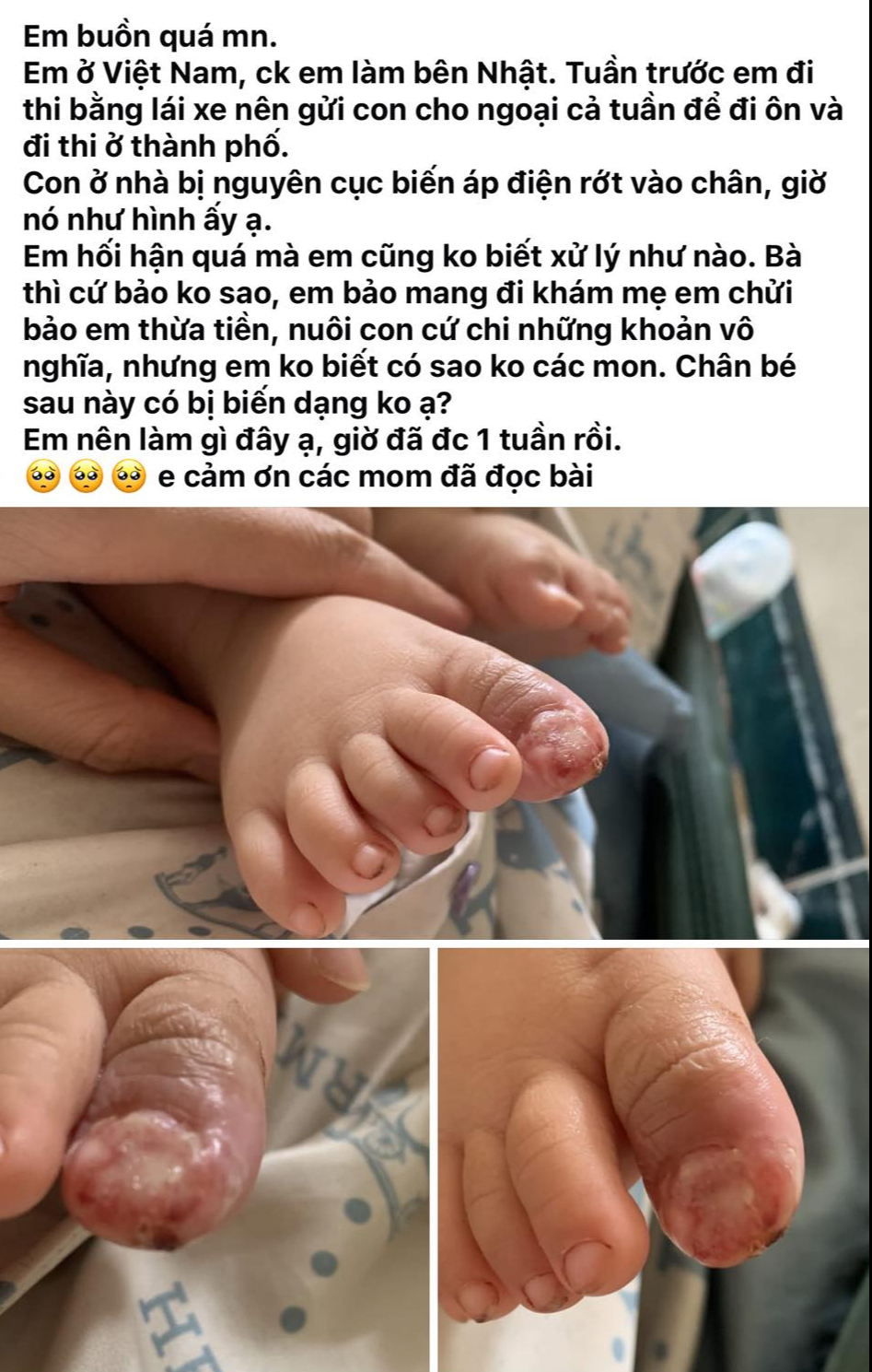 Con bị cục biến áp điện rơi vào chân đến biến dạng nhưng mẹ không dám cho đi khám vì bà ngoại mắng 
