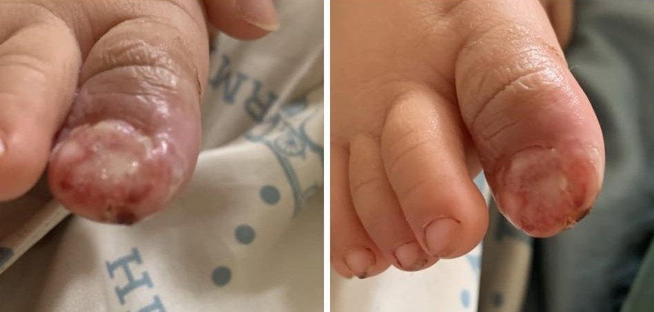 Con bị cục biến áp điện rơi vào chân đến biến dạng nhưng mẹ không dám cho đi khám vì bà ngoại mắng 