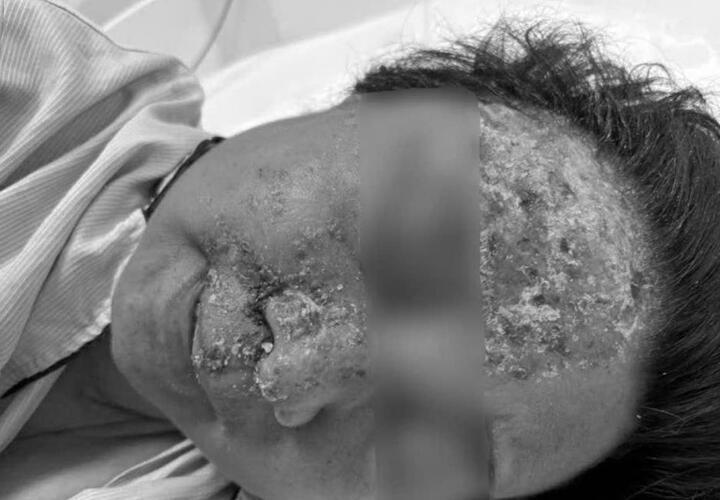 Nổi mụn nước tưởng dị ứng da, không ngờ nhiễm virus gây biến chứng nguy hiểm - Ảnh 1.