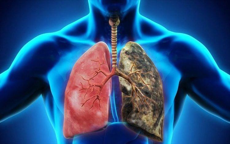 Bác sĩ đi mua nhà, nhìn thấy tay nhân viên môi giới liền bảo cô đi khám ngay, kết quả là ung thư phổi: Dấu hiệu nào mà "nhìn một cái thấy ngay"- Ảnh 3. Bác sĩ đi mua nhà, nhìn thấy tay nhân viên môi giới liền bảo cô đi khám ngay, kết quả là ung thư phổi: Dấu hiệu nào mà "nhìn một cái thấy ngay"- Ảnh 3.