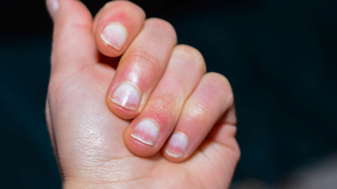 Bác sĩ đi mua nhà, nhìn thấy tay nhân viên môi giới liền bảo cô đi khám ngay, kết quả là ung thư phổi: Dấu hiệu nào mà "nhìn một cái thấy ngay"- Ảnh 2. Bác sĩ đi mua nhà, nhìn thấy tay nhân viên môi giới liền bảo cô đi khám ngay, kết quả là ung thư phổi: Dấu hiệu nào mà "nhìn một cái thấy ngay"- Ảnh 2.