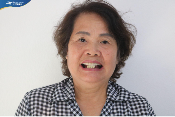 Trồng răng: Không phải cha mẹ không muốn, mà vì…! - Ảnh 1. Trồng răng: Không phải cha mẹ không muốn, mà vì…! - Ảnh 1.