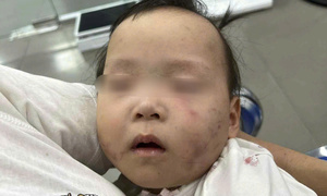 Bé gái 1 tuổi bị bầm tím mặt khi gửi nhà trẻ ở Bắc Ninh: Công an tạm giữ cô giáo - Ảnh 2. Bé gái 1 tuổi bị bầm tím mặt khi gửi nhà trẻ ở Bắc Ninh: Công an tạm giữ cô giáo - Ảnh 2.