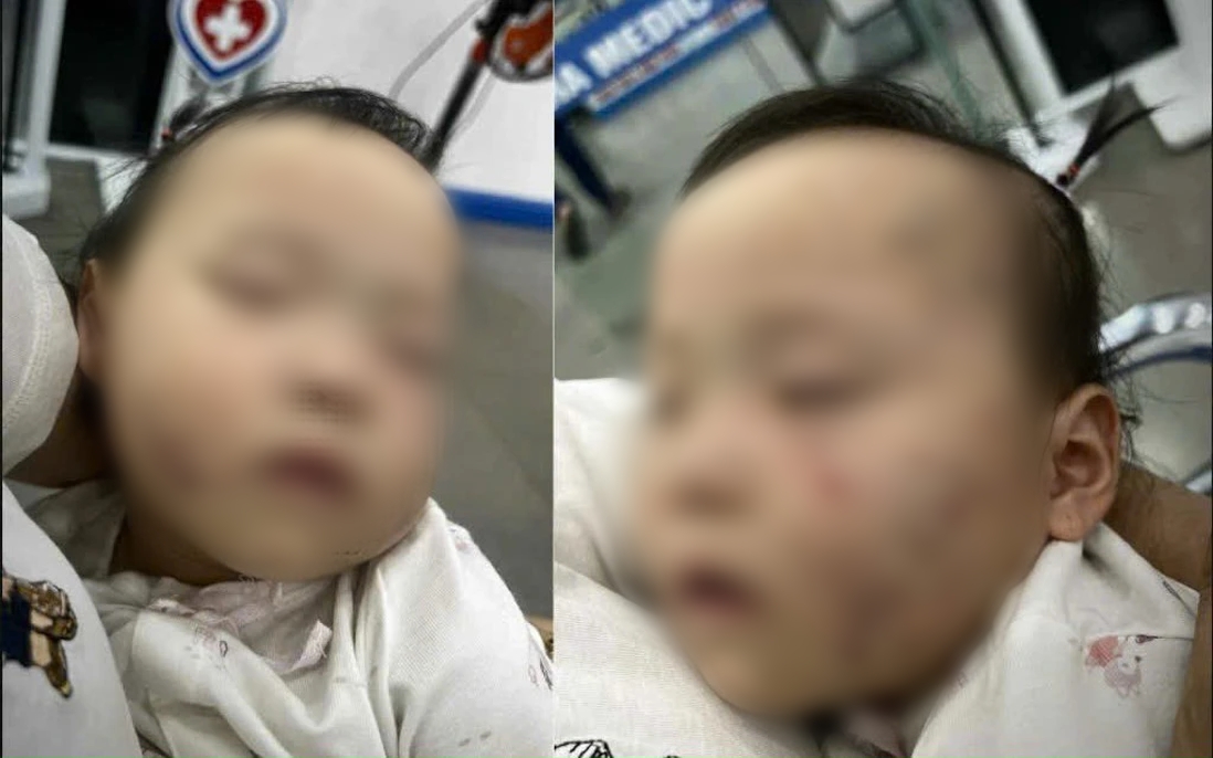 Vụ bé gái bầm tím mặt, có vết răng cắn sau khi đi học mầm non tư thục: Thông tin bất ngờ về cô giáo - Ảnh 1. Vụ bé gái bầm tím mặt, có vết răng cắn sau khi đi học mầm non tư thục: Thông tin bất ngờ về cô giáo - Ảnh 1.