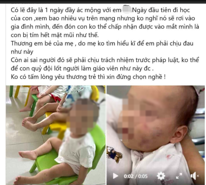 Bé gái bị bầm tím mặt sau khoảng 7 tiếng ở nhà trẻ tư thục: Tình trạng sức khoẻ hiện tại - Ảnh 1. Bé gái bị bầm tím mặt sau khoảng 7 tiếng ở nhà trẻ tư thục: Tình trạng sức khoẻ hiện tại - Ảnh 1.