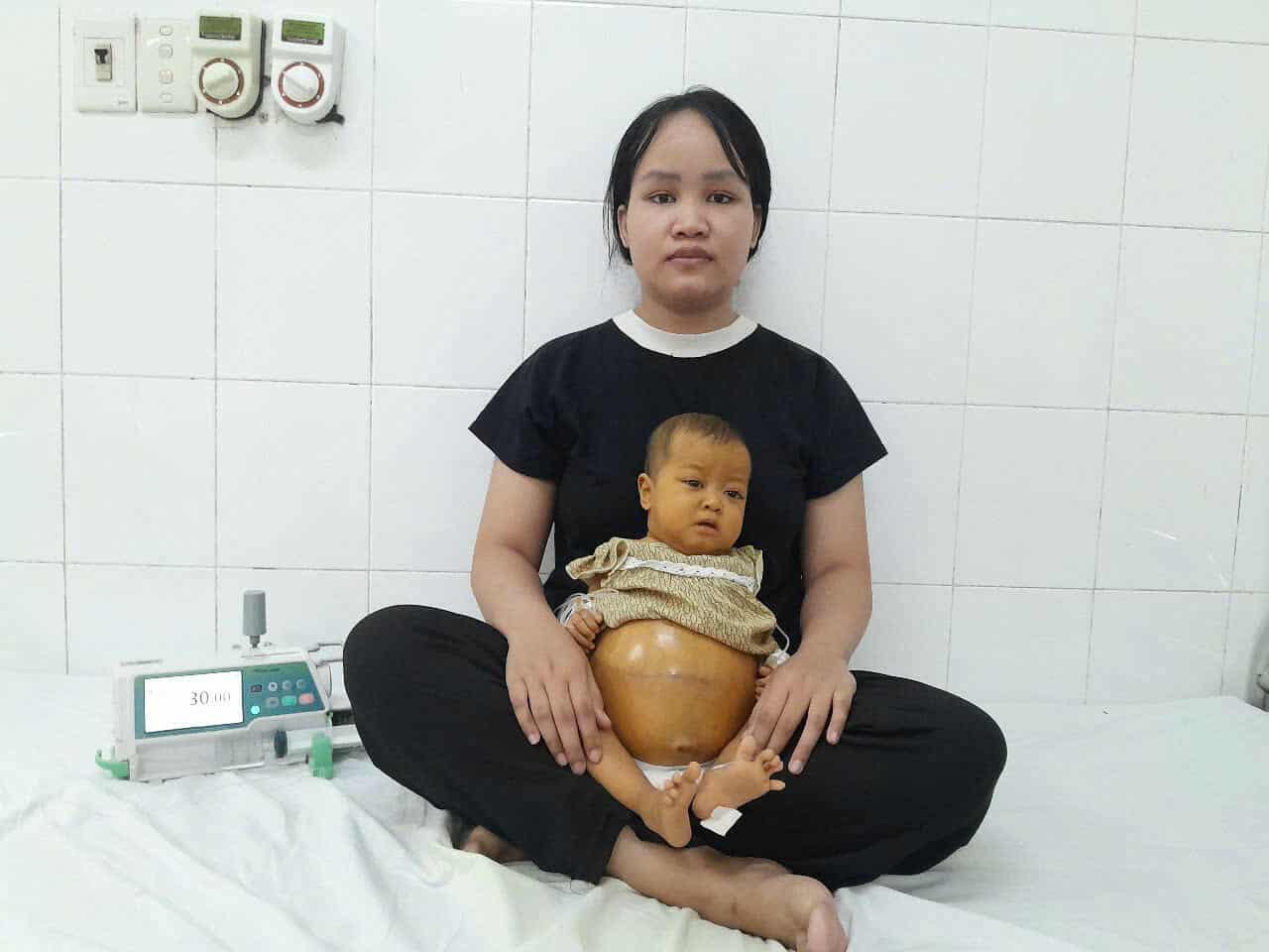 Ánh mắt cầu cứu của bé gái 6 tháng tuổi có bụng chực 