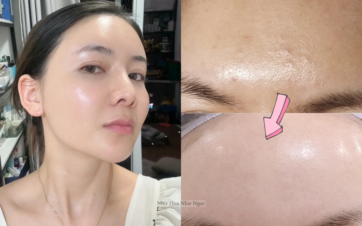 Thạc sĩ 36 tuổi chia sẻ hành trình trị mụn ẩn khoa học: Da sần sùi hóa láng mịn chỉ nhờ hiểu đúng - Ảnh 1. Thạc sĩ 36 tuổi chia sẻ hành trình trị mụn ẩn khoa học: Da sần sùi hóa láng mịn chỉ nhờ hiểu đúng - Ảnh 1.