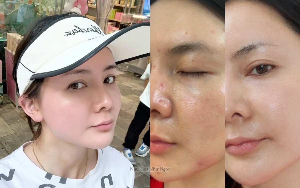 Thạc sĩ 36 tuổi chia sẻ hành trình trị mụn ẩn khoa học: Da sần sùi hóa láng mịn chỉ nhờ hiểu đúng - Ảnh 2. Thạc sĩ 36 tuổi chia sẻ hành trình trị mụn ẩn khoa học: Da sần sùi hóa láng mịn chỉ nhờ hiểu đúng - Ảnh 2.