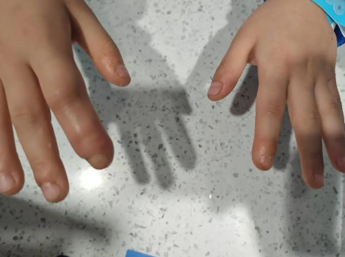 Trẻ hay cắn m&oacute;ng tay? Cẩn thận &ldquo;cắn&rdquo; ra vấn đề nghi&ecirc;m trọng, bố mẹ đừng chủ quan!- Ảnh 1.