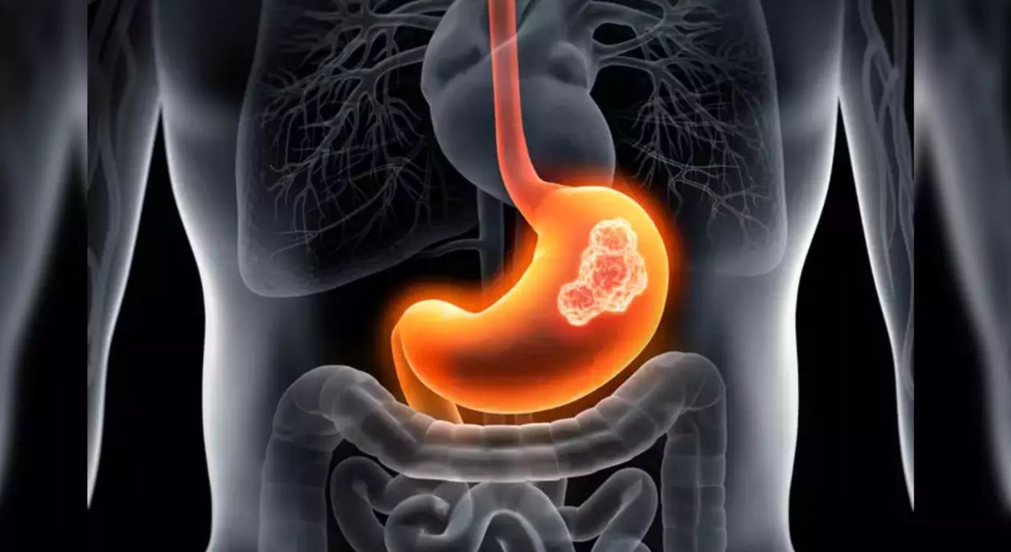 C&oacute; dấu hiệu n&agrave;y suốt nửa năm nhưng kh&ocirc;ng đi kh&aacute;m, thanh ni&ecirc;n 17 tuổi mắc ung thư giai đoạn cuối - Ảnh 1.