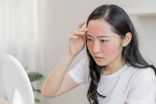 Nữ nghệ sĩ khổ sở v&igrave; bệnh da suốt 7 năm, s&aacute;ng soi gương l&agrave; bật kh&oacute;c: B&aacute;c sĩ cảnh b&aacute;o bệnh trứng c&aacute; đỏ kh&ocirc;ng chỉ li&ecirc;n quan đến da mặt - Ảnh 5.