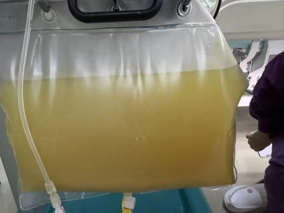 Ph&aacute;t hiện nguy&ecirc;n nh&acirc;n đau bụng của người phụ nữ 38 tuổi do th&oacute;i quen ăn uống - Ảnh 2.
