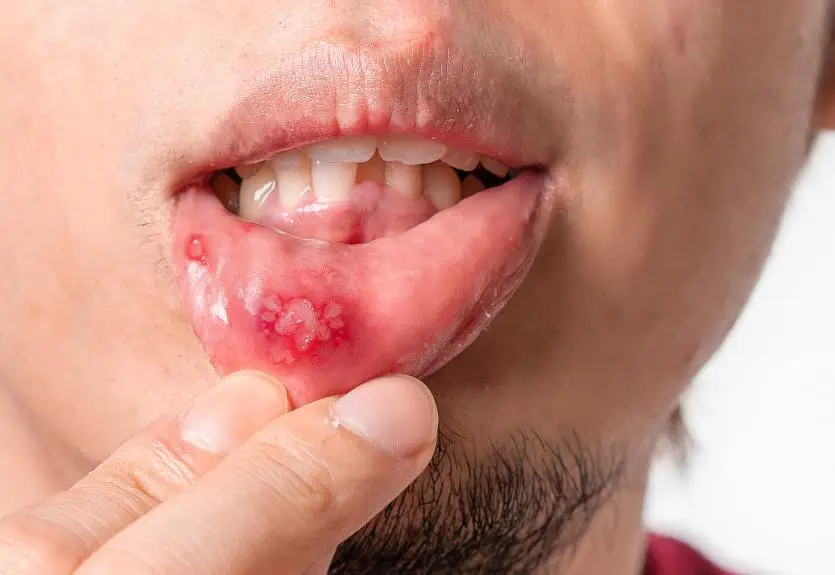 Cơ thể bạn không biết nói dối: 3 dấu hiệu phổ biến của hệ miễn dịch suy yếu, hãy xem bạn có bao nhiêu trong số đó - Ảnh 4.