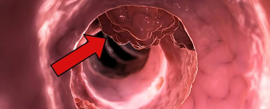 Khảo s&aacute;t 522 người tử vong v&igrave; ung thư đại trực tr&agrave;ng v&agrave; những th&oacute;i quen nguy hiểm - Ảnh 1.