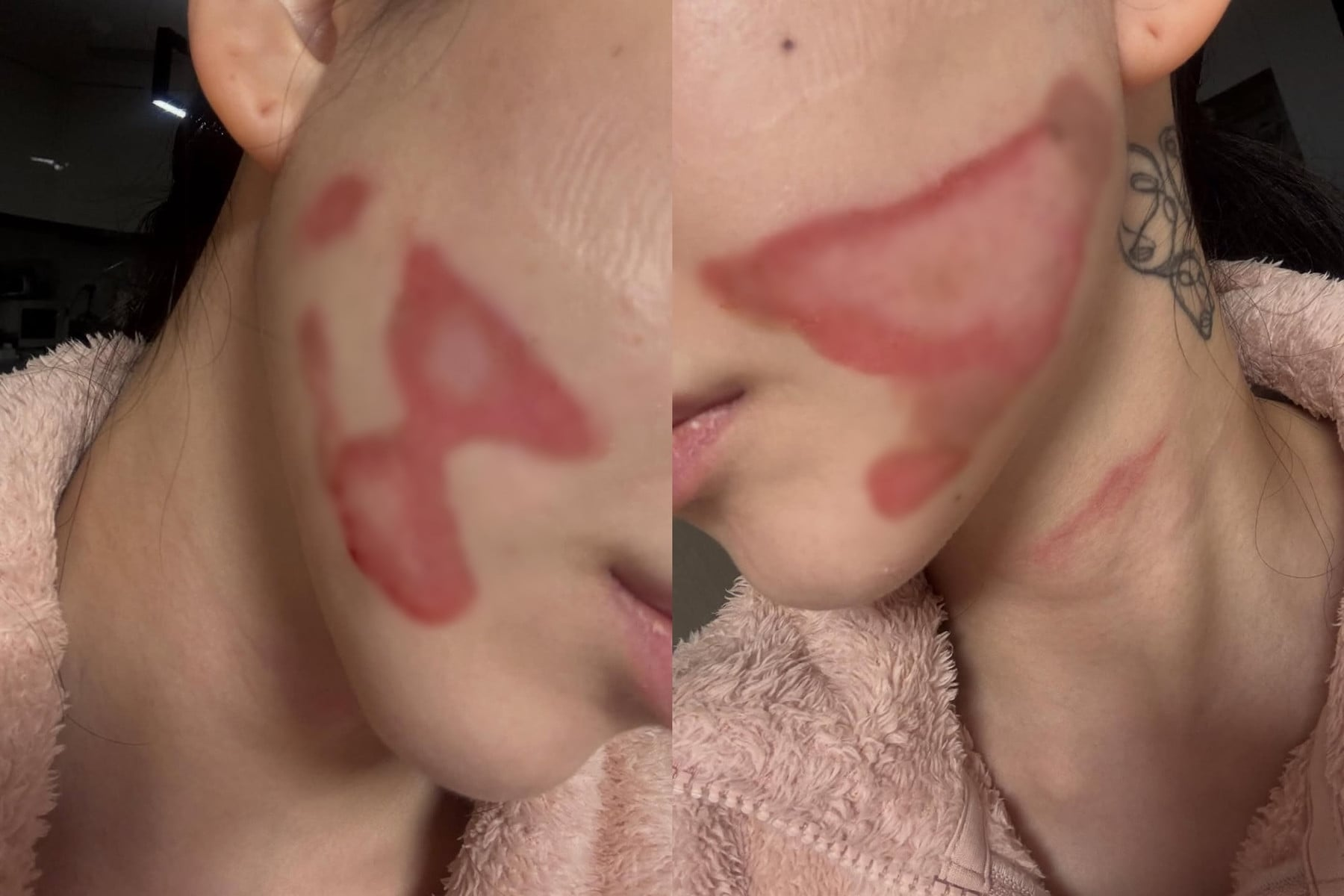 Nữ ca sĩ mất Tết, bị bỏng nặng một b&ecirc;n mặt khi đi l&agrave;m đẹp- Ảnh 2.