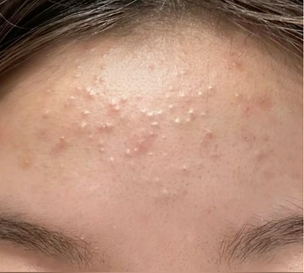 V&igrave; sao Gel hỗ trợ giảm mụn mờ th&acirc;m Actidem Derma Gel được nhiều người da mụn tin d&ugrave;ng? - Ảnh 1.