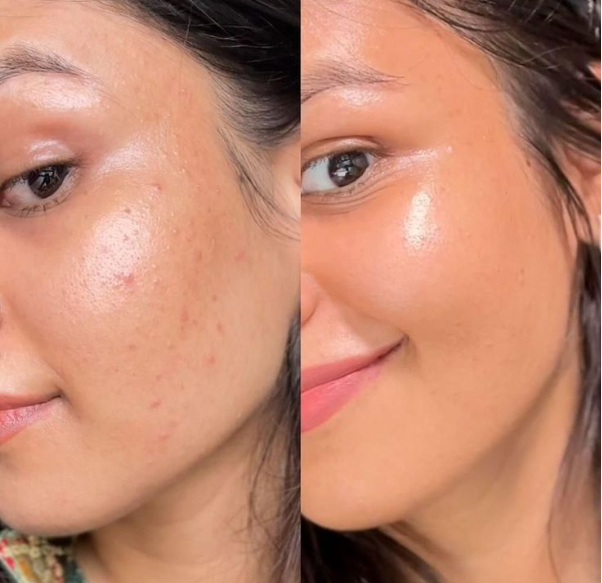 V&igrave; sao Gel hỗ trợ giảm mụn mờ th&acirc;m Actidem Derma Gel được nhiều người da mụn tin d&ugrave;ng? - Ảnh 5.