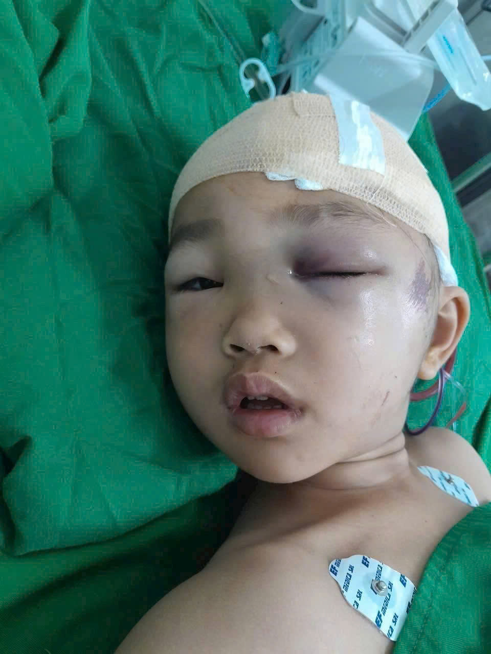 Ngã từ tầng 2 ngày mùng 2 Tết, bé gái 6 tuổi nguy kịch, gia đình nghèo kiệt quệ cầu cứu - Ảnh 2.