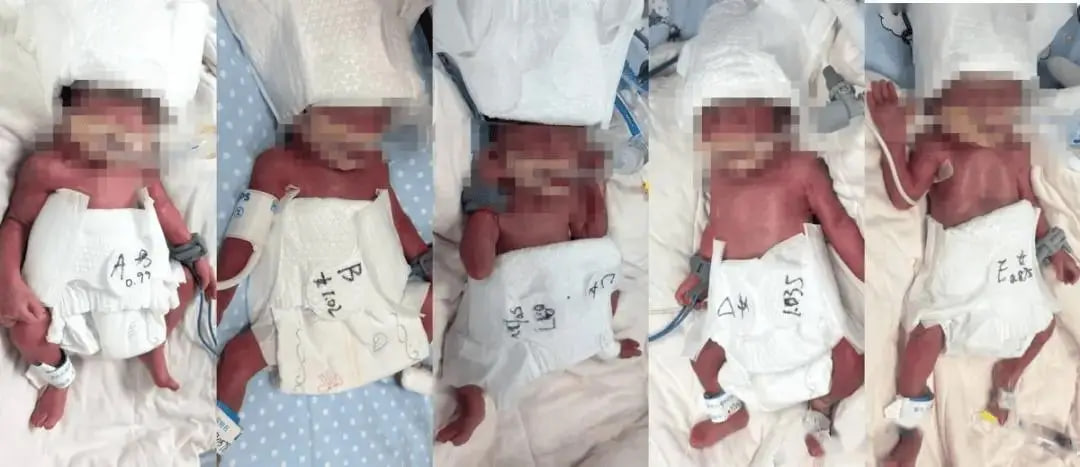 Kỳ t&iacute;ch chỉ chiếm 1/60 triệu ca, sản phụ 24 tuổi sinh 5: 1 b&eacute; trai, 4 b&eacute; g&aacute;i ch&agrave;o đời an to&agrave;n - Ảnh 1.