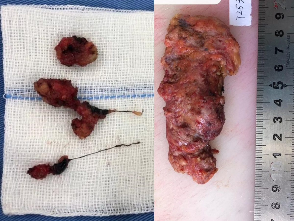 Mẹ v&ocirc; t&igrave;nh ph&aacute;t hiện dịch m&agrave;u v&agrave;ng tr&ecirc;n &aacute;o l&oacute;t b&eacute; g&aacute;i 13 tuổi, kết quả si&ecirc;u &acirc;m g&acirc;y sốc v&igrave;&hellip;- Ảnh 2.