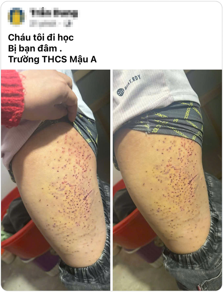 Học sinh L&agrave;o Cai nghi bị bạn d&ugrave;ng vật nhọn g&acirc;y thương t&iacute;ch, ch&iacute;nh quyền v&agrave;o cuộc - Ảnh 1.