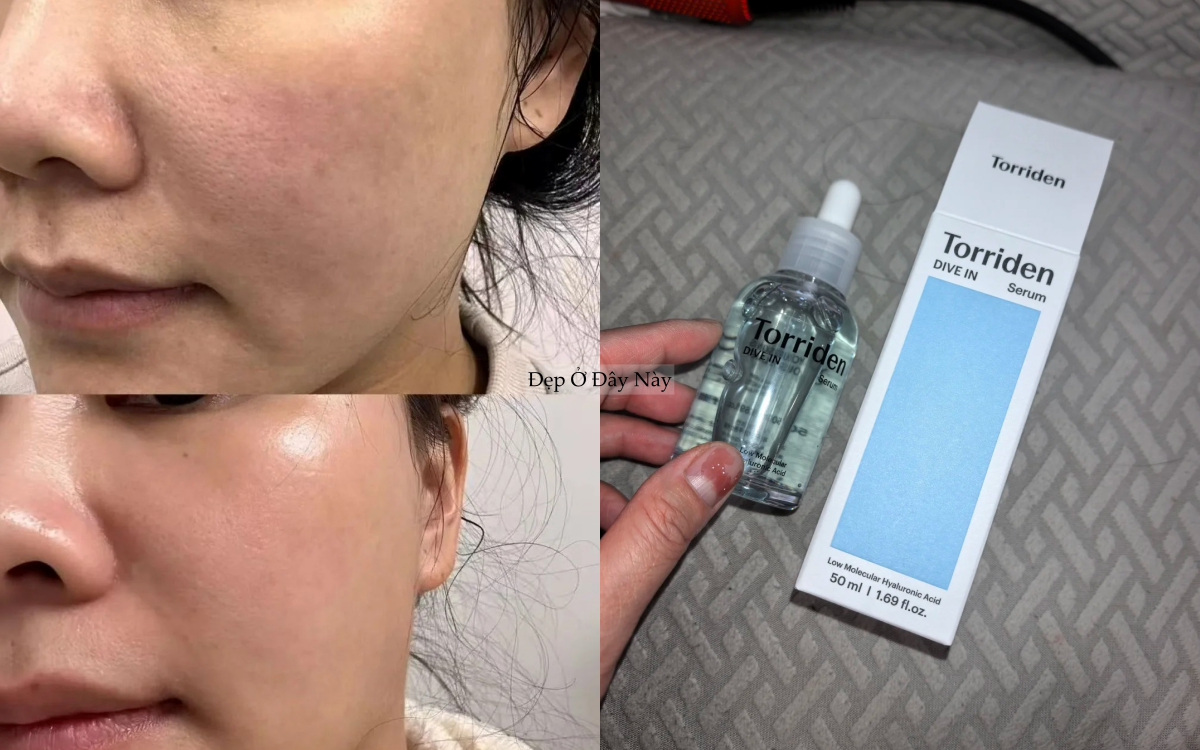 Chuyên gia chỉ ra: Có tới 4 loại lỗ chân lông to và cách khắc phục hiệu quả nhất - Ảnh 3.